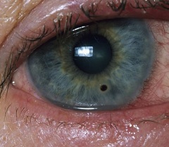 Чувство жжения один из симптомов инородного тела в глазу